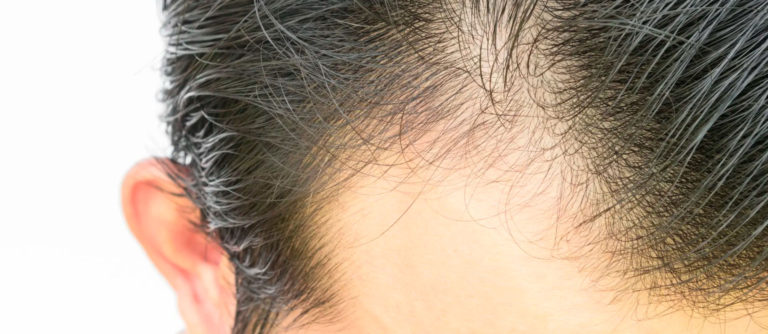 Leia mais sobre o artigo Queda de cabelo – Alopécia Androgenética